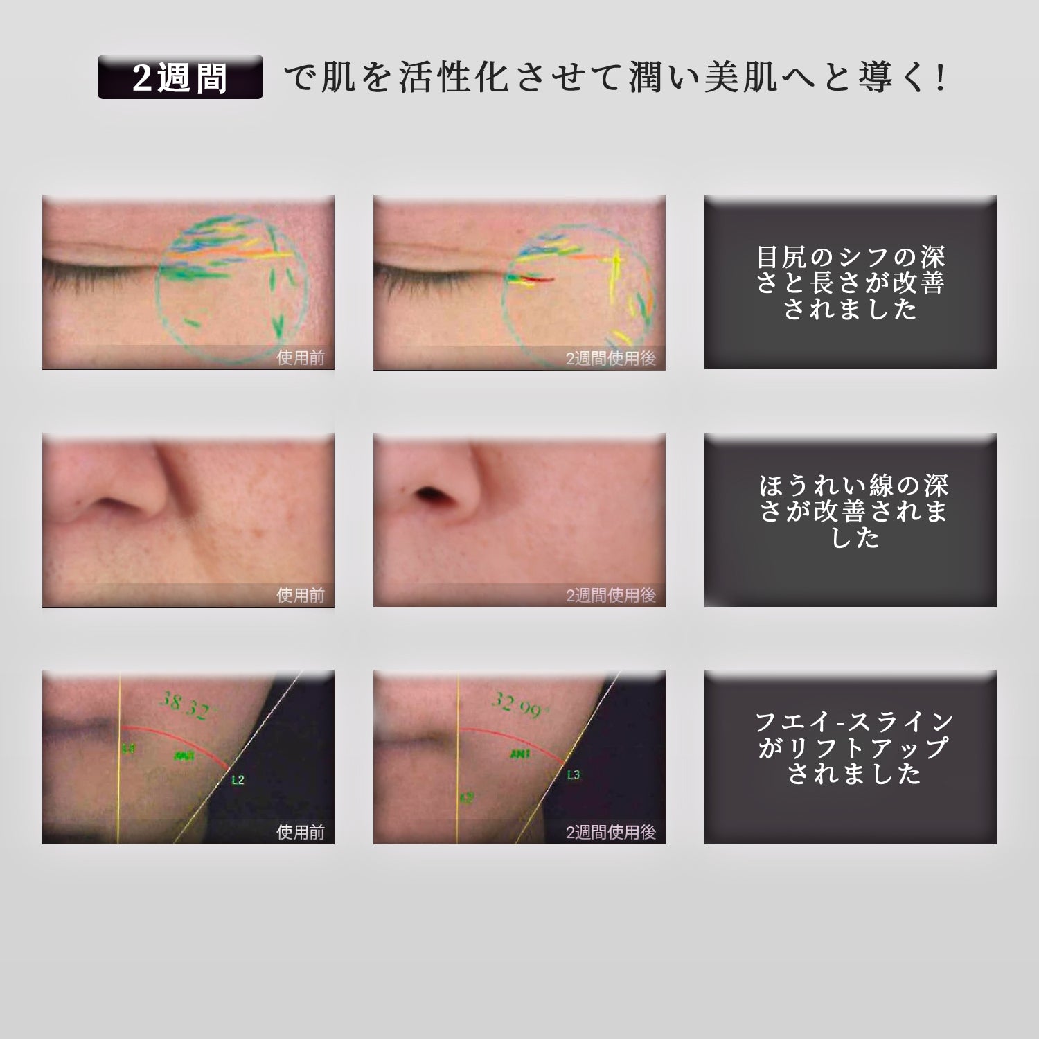 RF美顔器 AMIRO R1 PRO